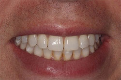 Close up of smile before cosmetic dental bonding